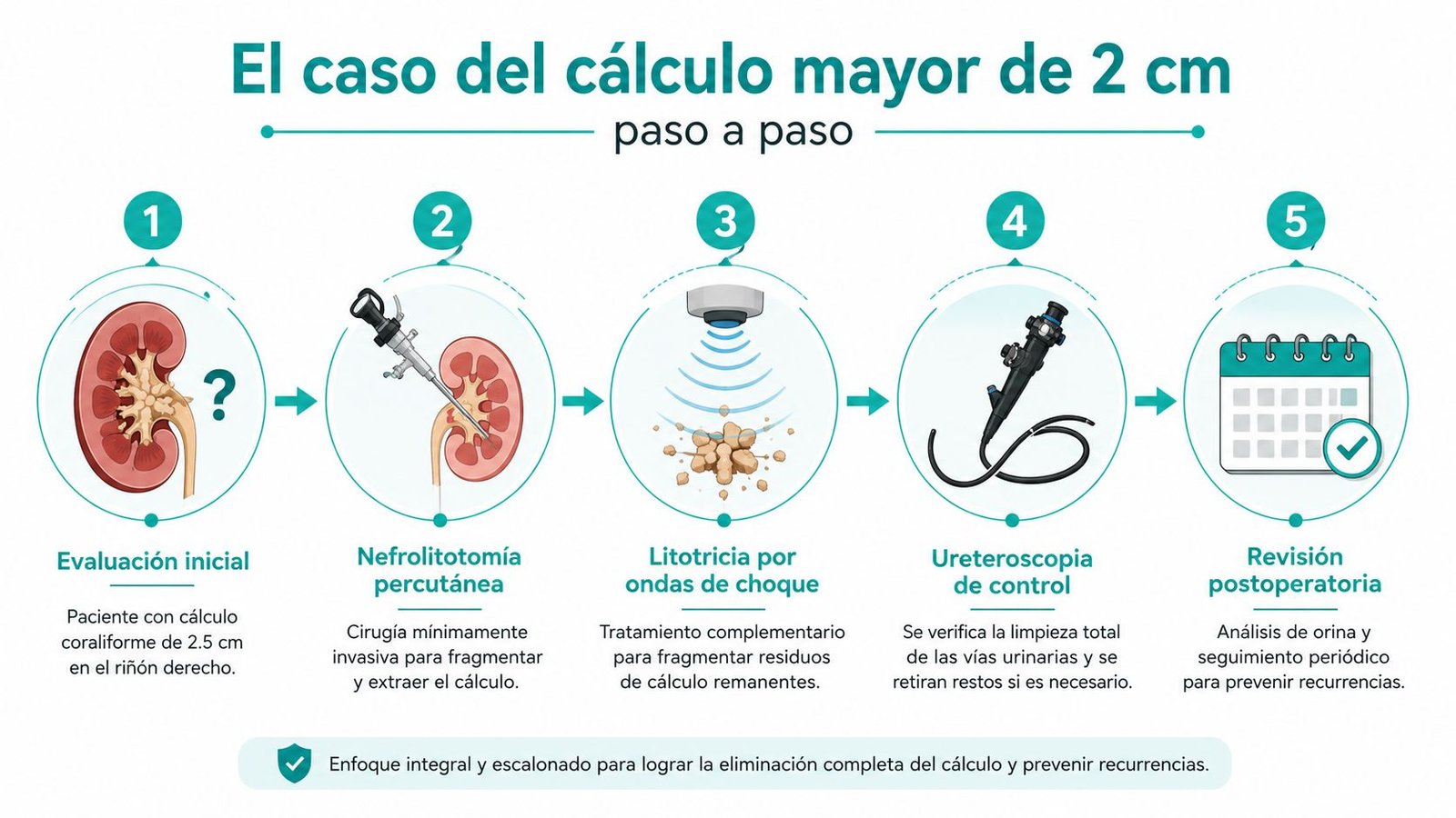 Infografía paso a paso sobre el proceso médico para el tratamiento de cálculos renales mayores de 2 cm.