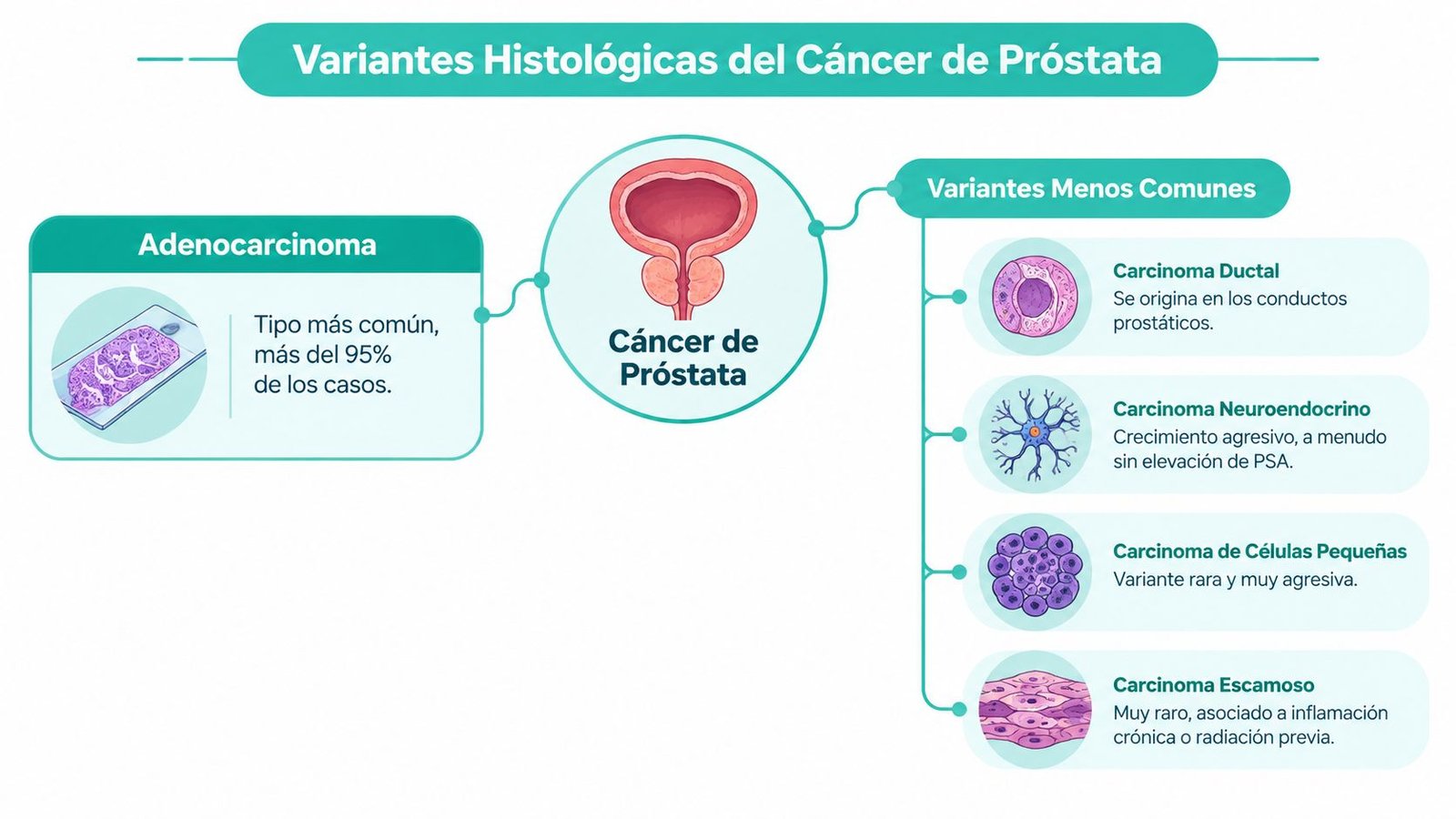 Infografía que muestra las variantes histológicas del cáncer de próstata, incluyendo el adenocarcinoma y tipos menos comunes.